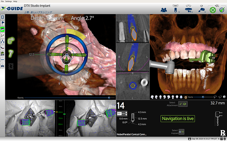X-ガイドを用いた「ダイナミック・ナビゲーションサージェリー」