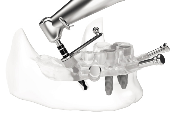 サージカルテンプレートを用いた「ガイデッド・サージェリー」。