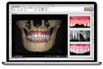 DTX Studio™️Implantソフトウェア